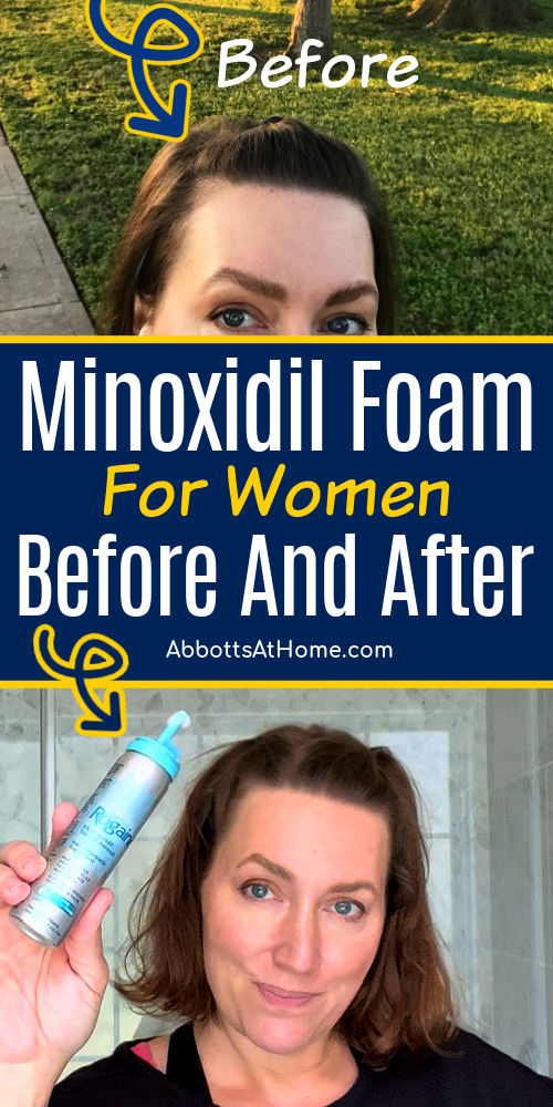 minoxidil for women before and after, minoxidil before and after women, rogaine women before and after